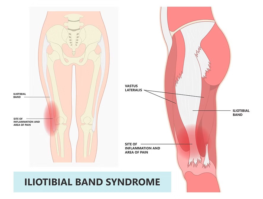 Iliotibial Band Syndrome ITBS