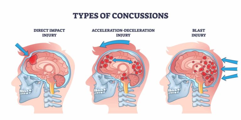 Complete Concussion Treatment in Houston: What Advance Physical Therapy Can Help